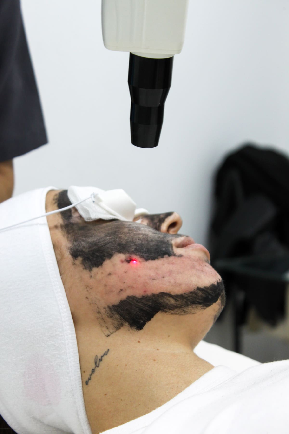 Tratamiento Hollywood Peel con carbón activo y láser en Clínica Bera